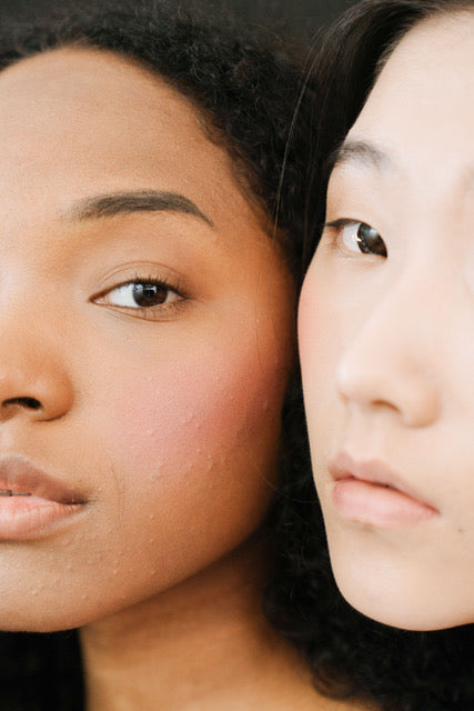 6 ways to treat your acne and prevent a breakout